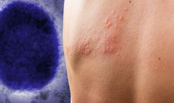 ΠΟΥ: Νέες διαγνωστικές εξετάσεις για την ευλογιά των πιθήκων