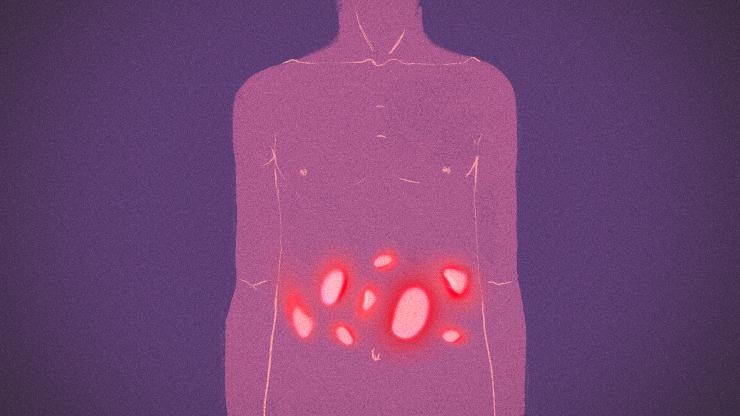Στρες, άγχος, απομόνωση – Η ζωή με τη νόσο του Crohn