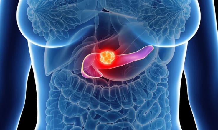 Καρκίνος Παγκρέατος: Η νόσος – προάγγελος που προειδοποιεί ένα χρόνο νωρίτερα