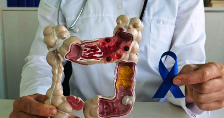 Καρκίνος παχέος εντέρου: 67.000 πολίτες παρέλαβαν το self-test - Πόσα είναι τα θετικά δείγματα