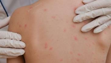 Ιλαρά: Σε επαγρύπνηση οι υγειονομικές αρχές στην Ελλάδα