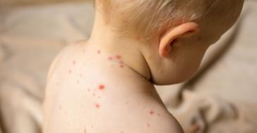 ΕΟΔΥ: Τρεις επιδημίες ιλαράς στην Ελλάδα από το 2004 ως το 2023