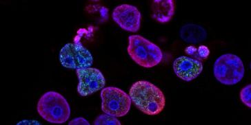 Αντικαταθλιπτικό φάρμακο δίνει ελπίδα για τη θεραπεία επιθετικού καρκίνου