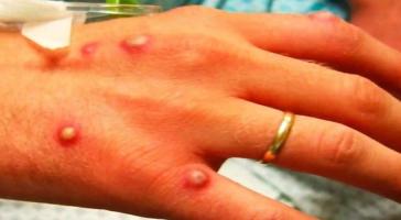 Ενημέρωση του ΕΟΔΥ για την ευλογιά των πιθήκων (monkeypox) 